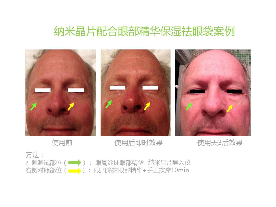 納晶納米晶片使用效果案例分享